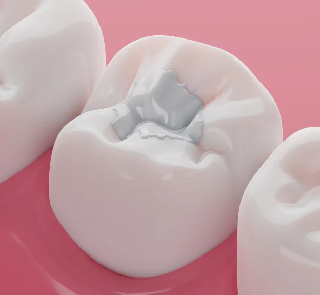 Natural-Looking Care for Dental Decay