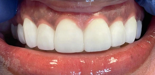 cosmetic dentistry smile makeover after