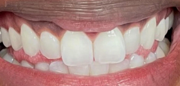 cosmetic dentistry smile makeover before