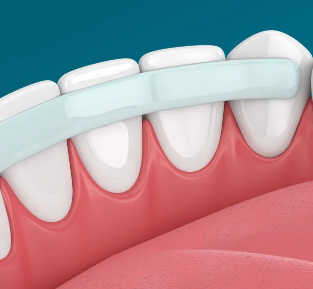 Natural-Looking Improvements with Dental Bonding