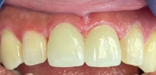 Dental Crowns After
