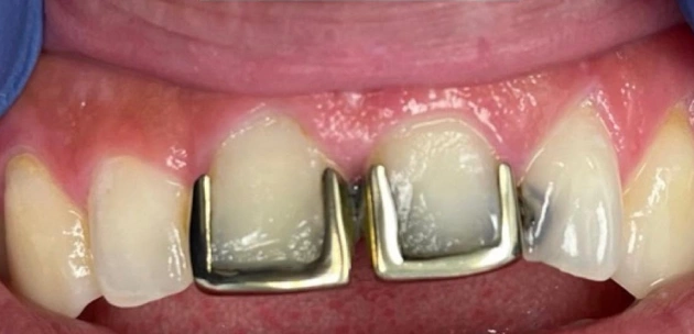 Dental Crowns before