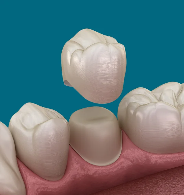 Restore Strength and Function to Damaged Teeth