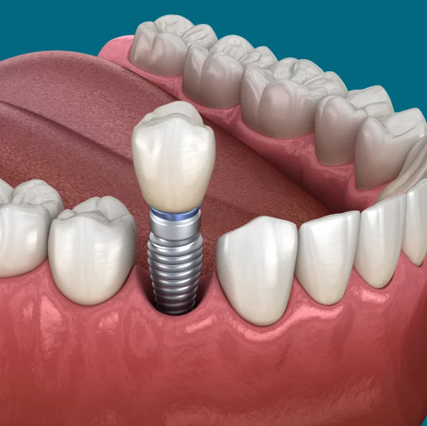 A Long-Term Solution for Missing Teeth
