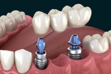 Implant-Supported Bridge