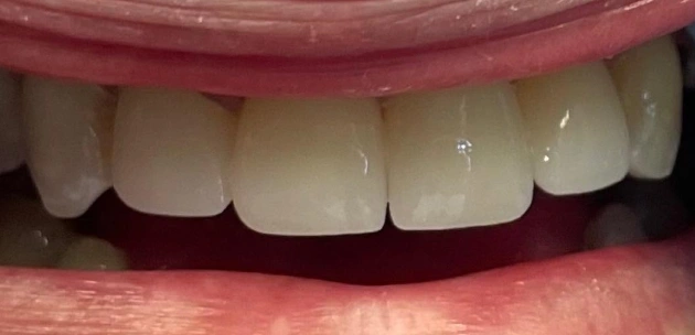 severely decayed teeth After