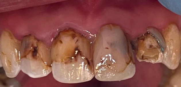severely decayed teeth before