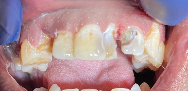 teeth dental treatment before
