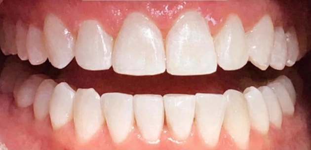 teeth whitening smile After