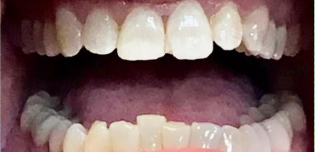 teeth whitening smile before