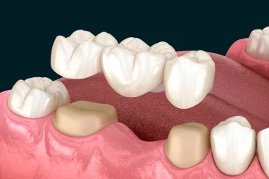 Traditional Dental Bridge